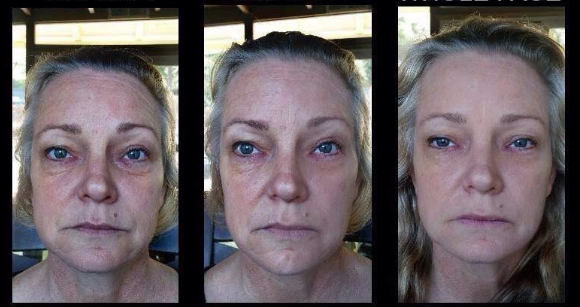 instantly-ageless-photo-before-and-after