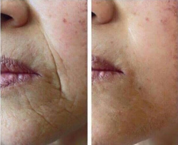 instantly-ageless-photo-before-and-after