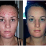 LUMINESCE™ Cellular Rejuvenation Serum - before and after
