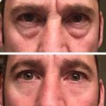 Instantly Ageless cream result - before and</p></div><div class=