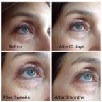JeunesseGlobal's micro-cream anti-wrinkle effect (90 days of applying)